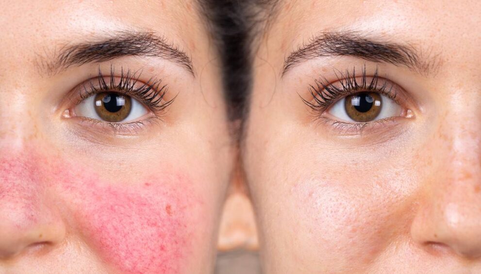 Rosacea