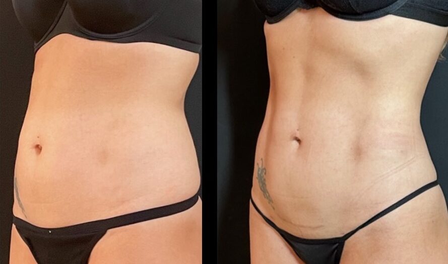 The Tummy Tuck