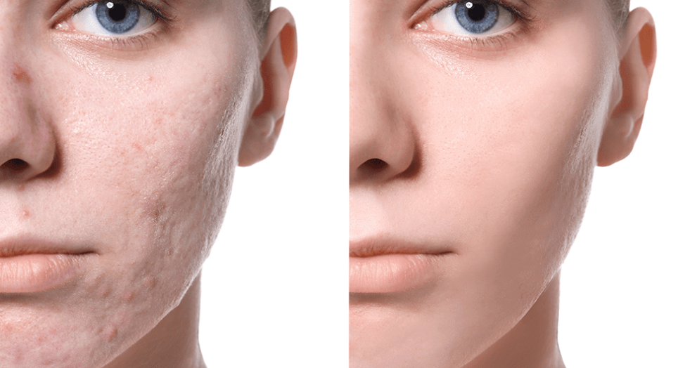 Acne Scar Removal