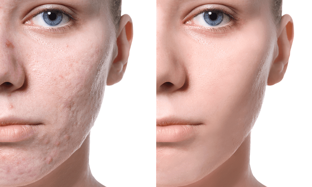 Acne Scar Removal