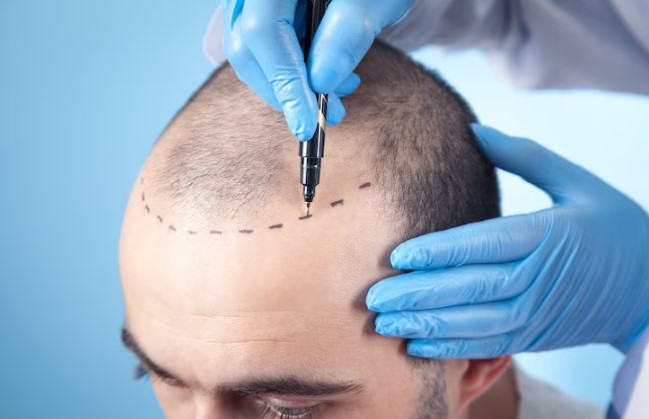 FUE Hair Transplant