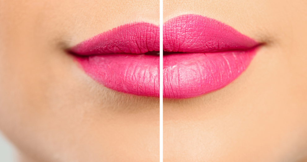 Lip Fillers and How They Work