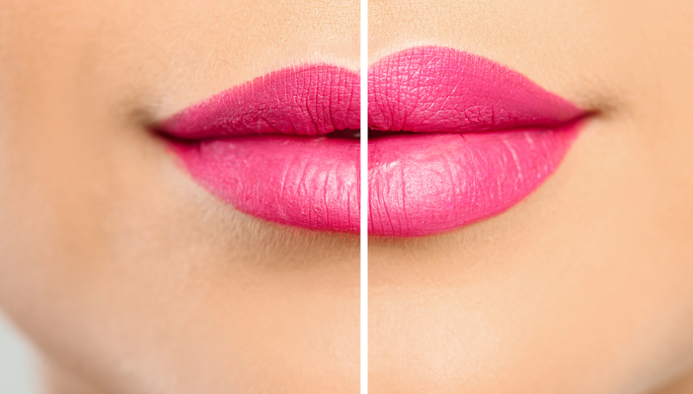 Lip Fillers and How They Work