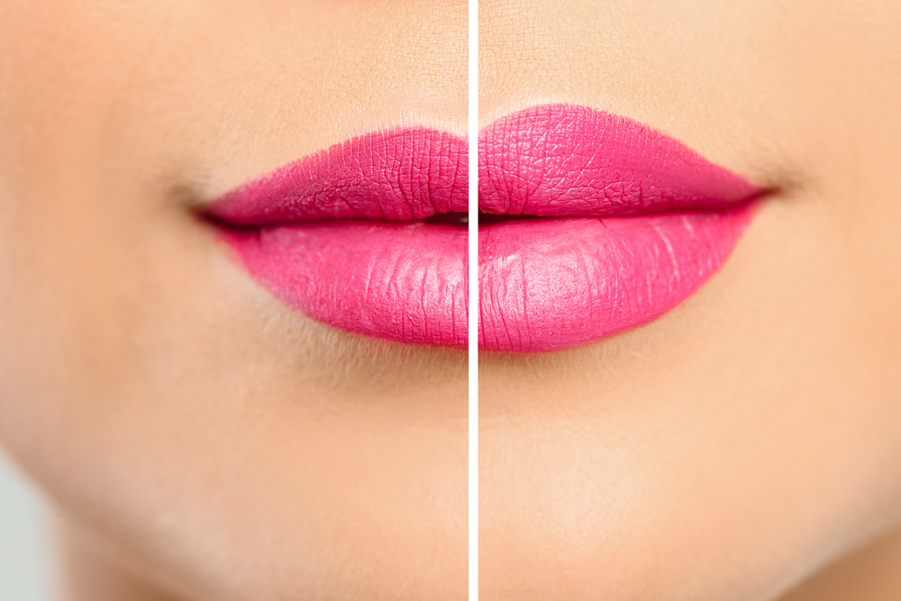 Lip Fillers and How They Work