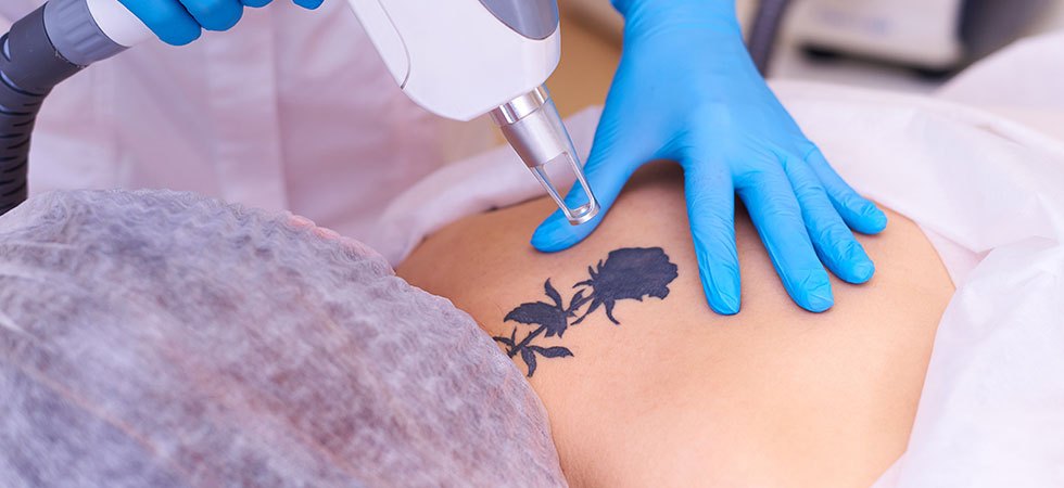 Laser Tattoo Removal