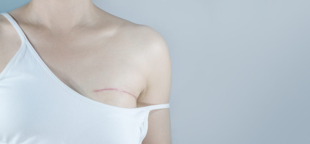 Mastectomy