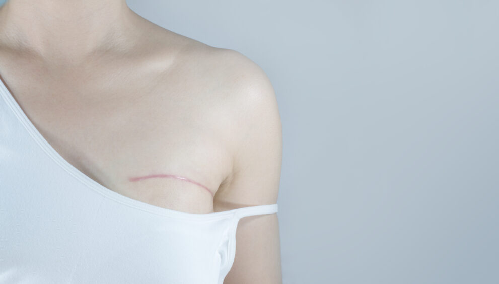 Mastectomy