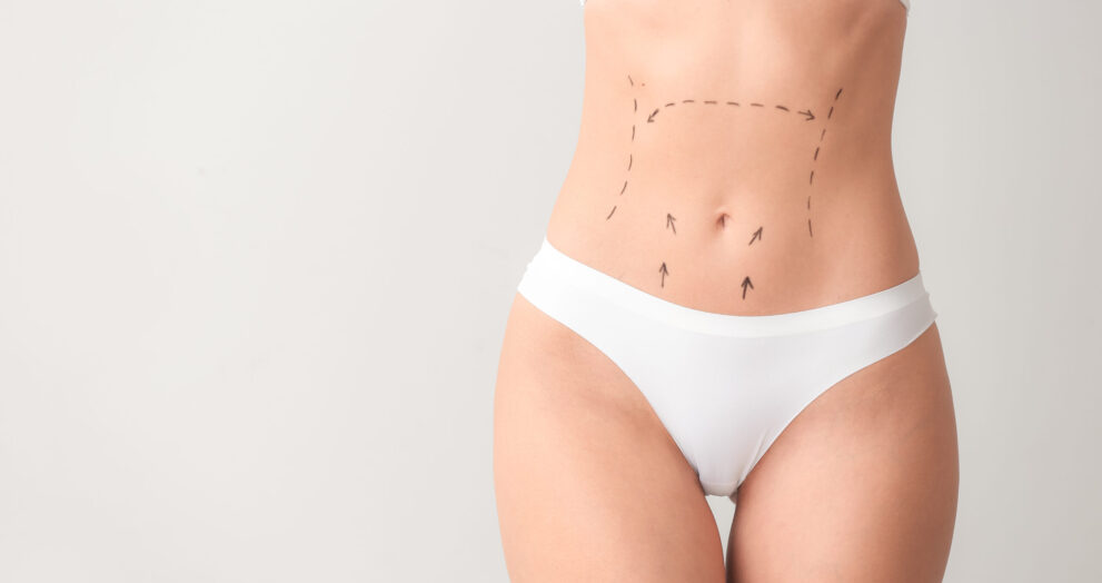 Tummy Tuck