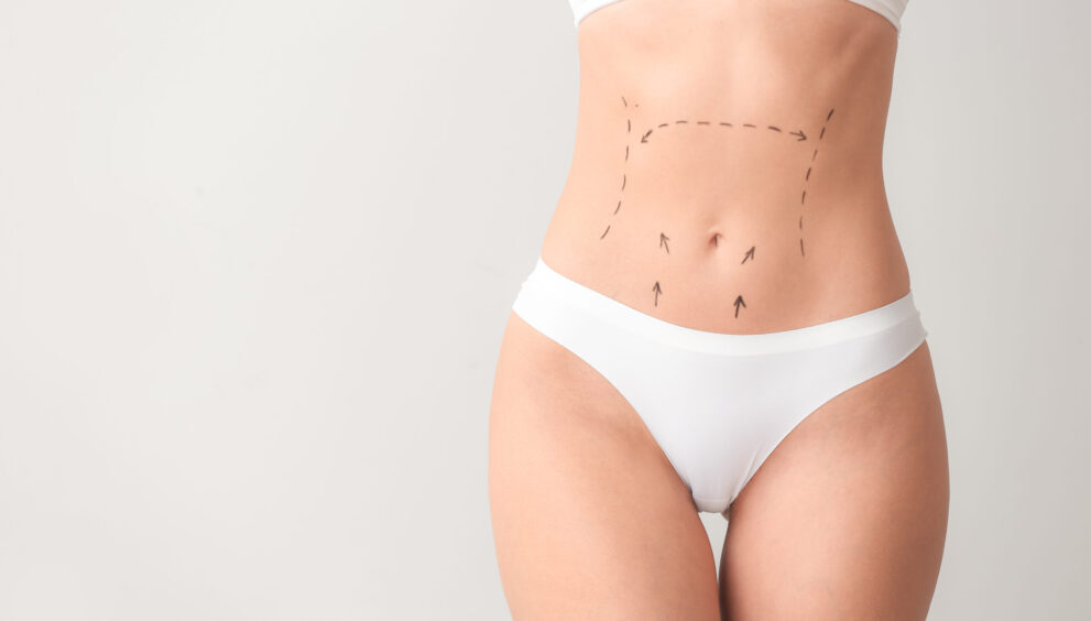 Tummy Tuck