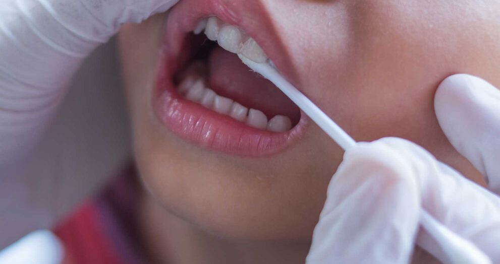Fluoride Varnish