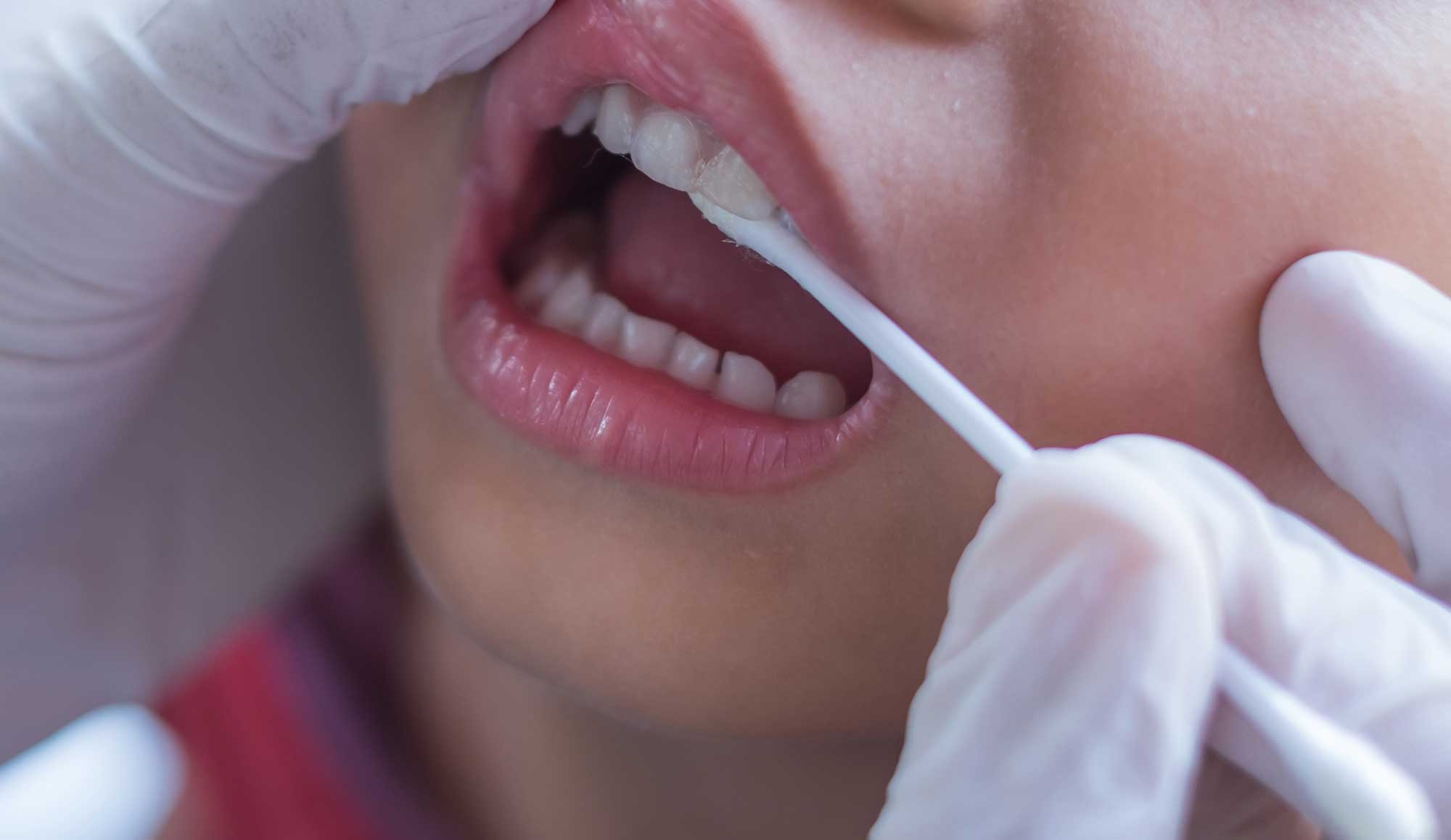 Fluoride Varnish