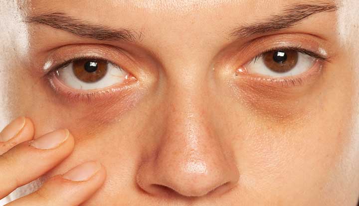 Eye Bags