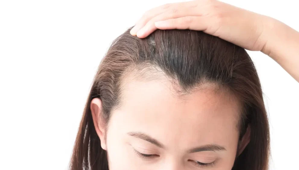 Hair Started Thinning Around the Hairline