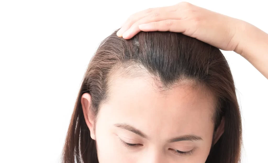 Hair Started Thinning Around the Hairline
