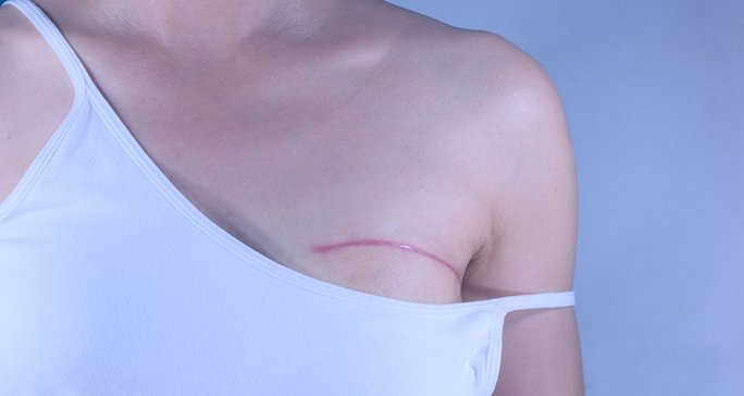 Mastectomy Breast