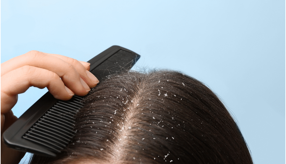 Which shampoo is the best for dandruff