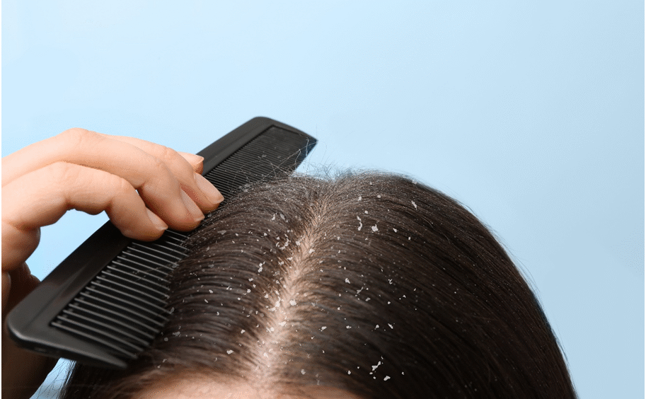 Which shampoo is the best for dandruff