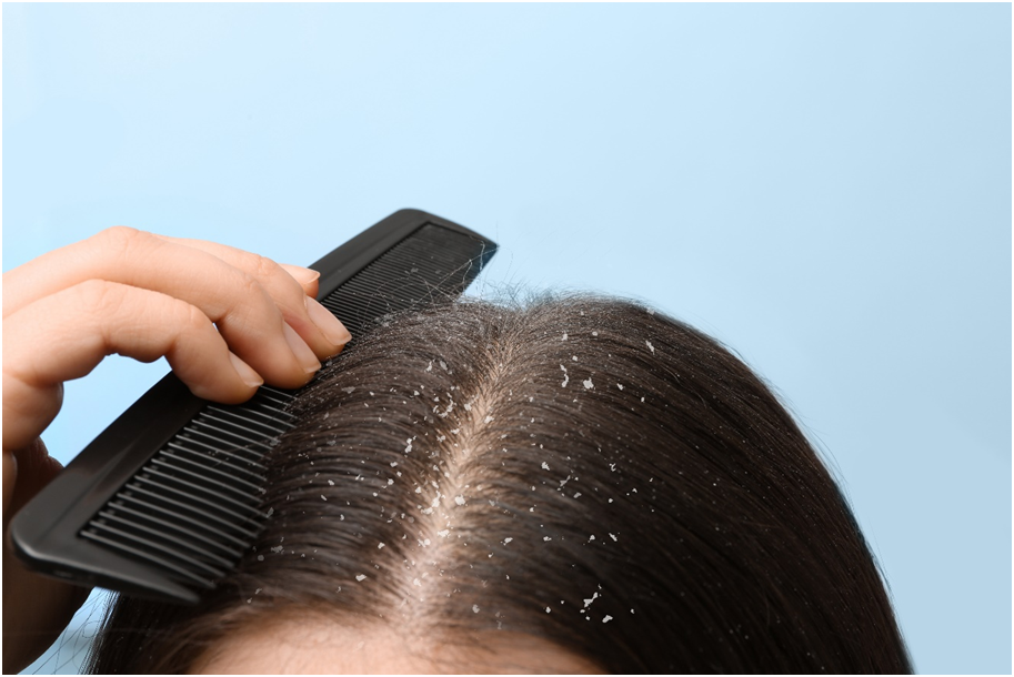 Which shampoo is the best for dandruff
