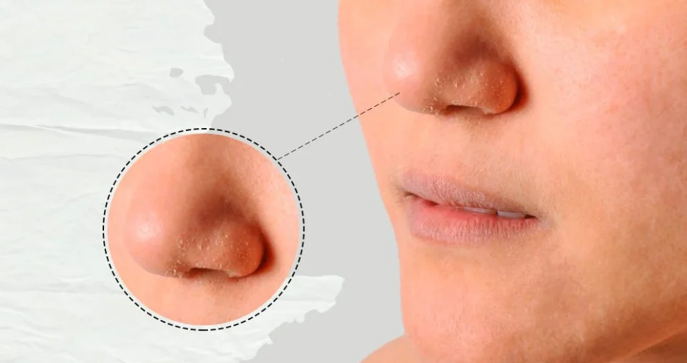 Dry Patches