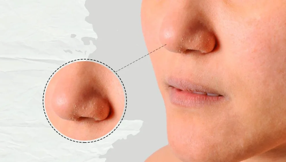 Dry Patches
