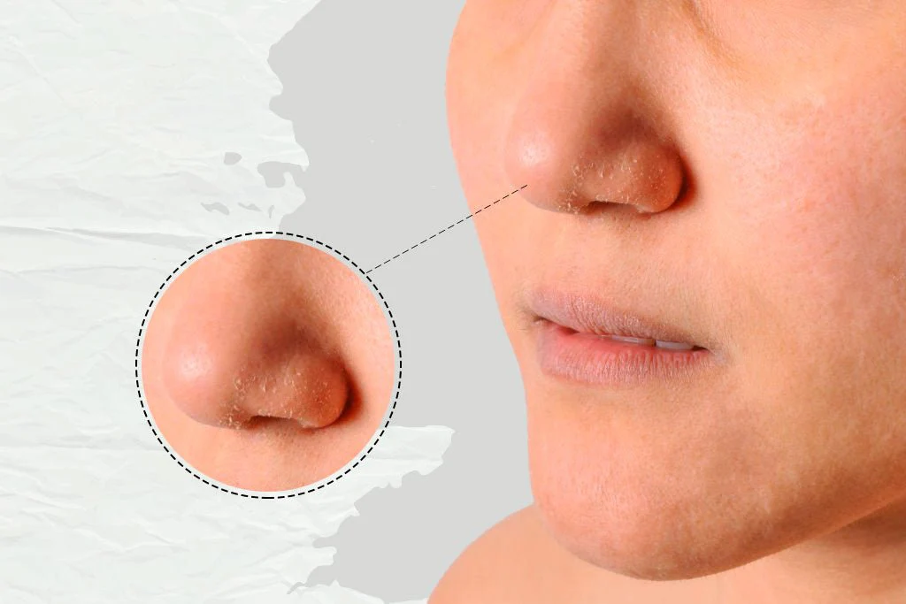 Dry Patches