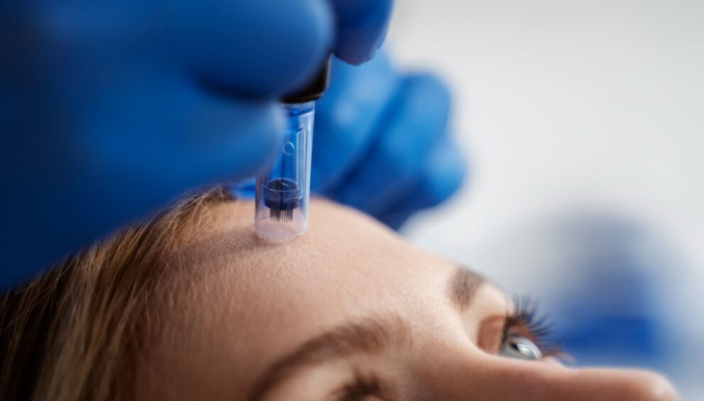 SkinPen Microneedling