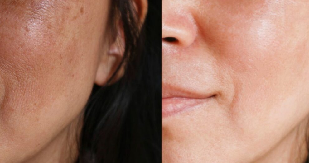 Uneven Texture and Dullness