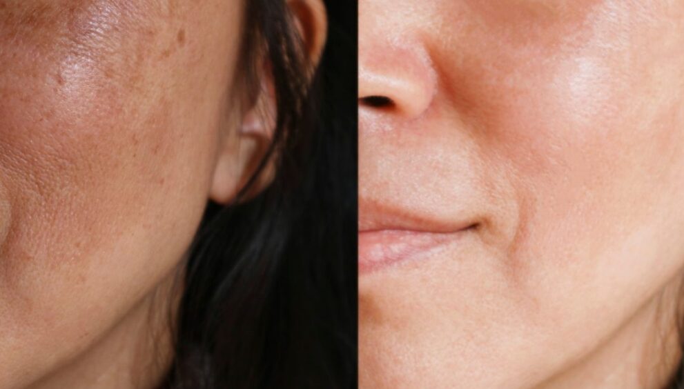 Uneven Texture and Dullness