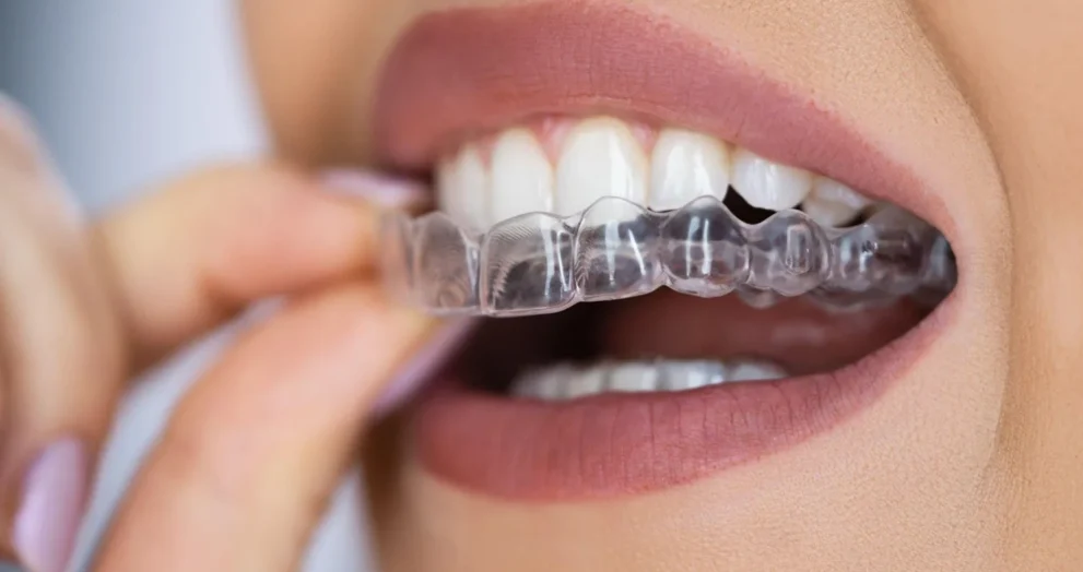 Invisalign