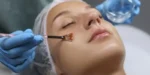 Chemical Peels in Phoenix: Benefits, Types, and What to Expect