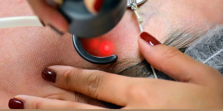 Fractional CO2 Laser Treatment